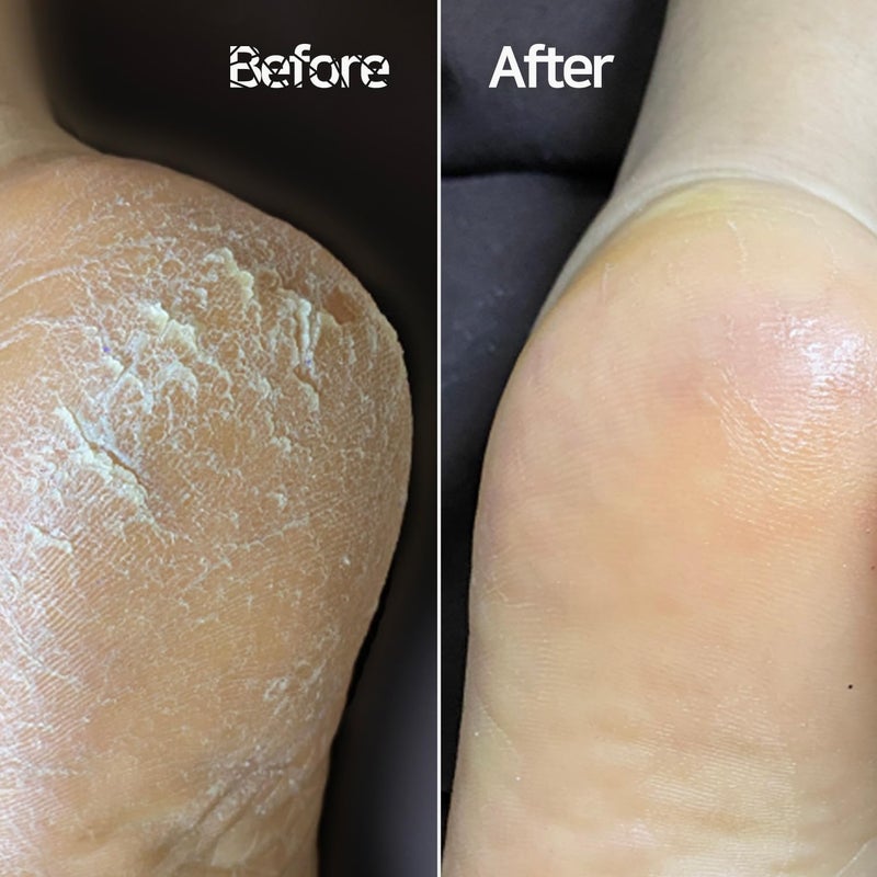 Baren Magic Professional Dual Sided Foot Callus Remover Shaver - Painless and Gentle Remove | Professional Tool | Premium Stainless Steel | for Dry Foot | Foot File | Easy to Clean - Image 2